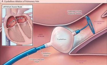 cryoballoon ablation