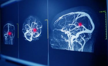 tumor otak