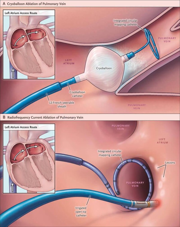 cryoballoon ablation