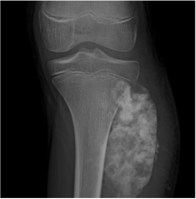 Conventional Osteosarcoma of the Fibula