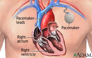 pacemaker