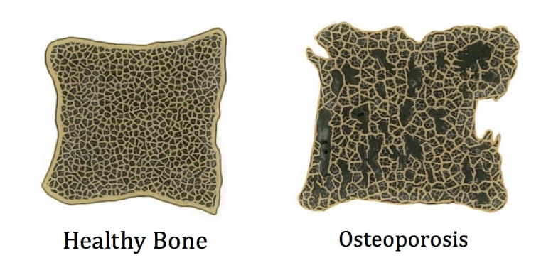 Mengenal Tulang Keropos Atau Osteoporosis