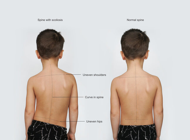 Know the Early Signs of Scoliosis and How to Detect It First